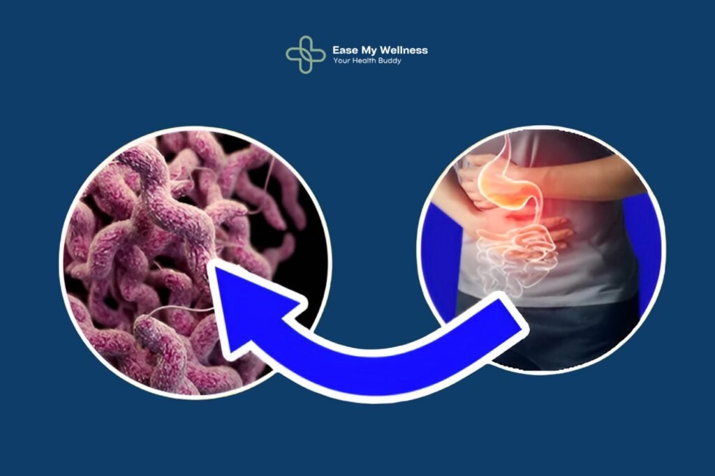 Guillain-Barre Syndrome (GBS)